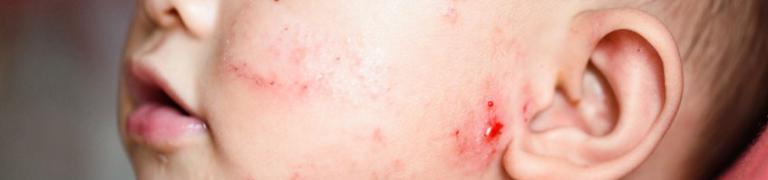 Natuurlijke behandeling voor eczeem