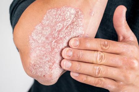 Psoriasis creme en hulp middeltjes.jpg