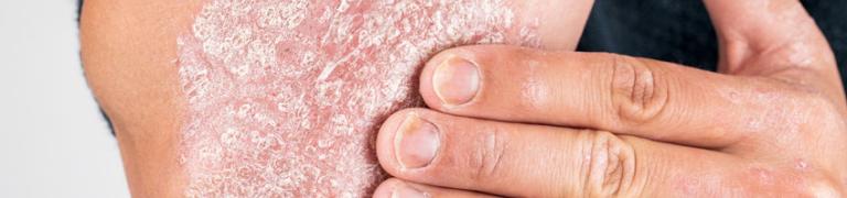 Natuurlijke behandeling Psoriasis